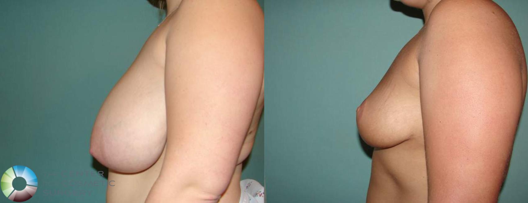 Before & After Breast Reduction Case 576 View #2 in Denver and Colorado Springs, CO