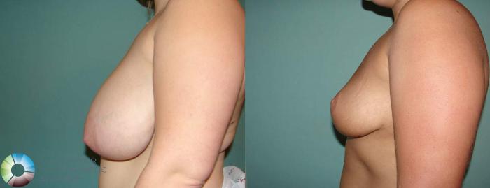 Before & After Breast Reduction Case 576 View #2 View in Golden, CO