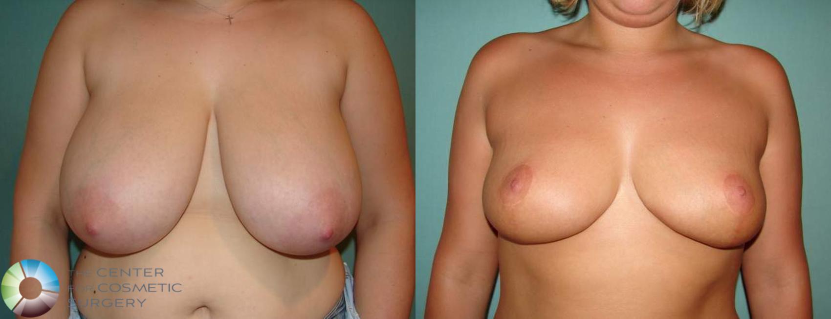 Before & After Breast Reduction Case 576 View #3 in Denver and Colorado Springs, CO
