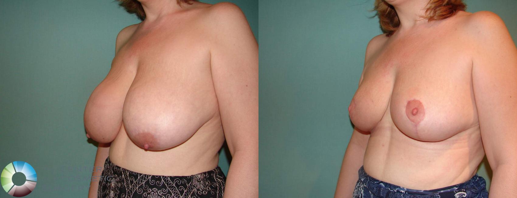 Before & After Breast Reduction Case 583 View #1 in Denver, CO