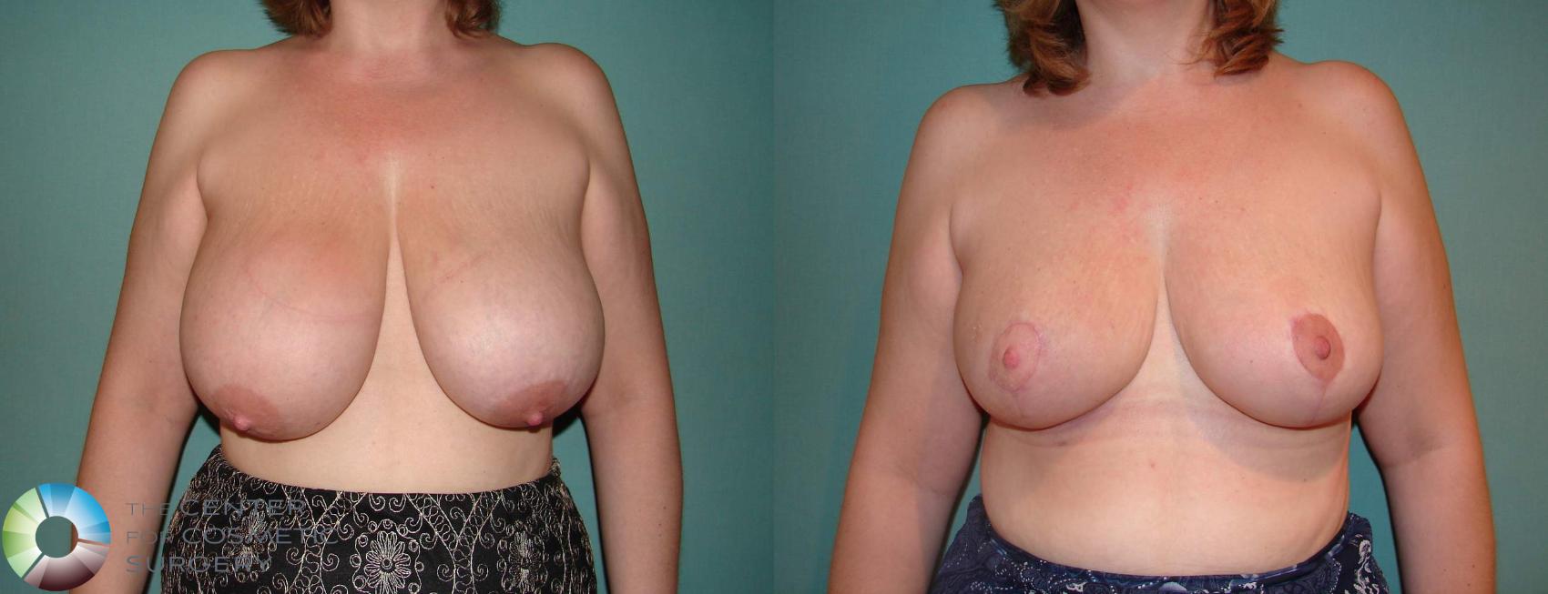 Before & After Breast Reduction Case 583 View #2 View in Golden, CO