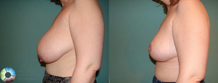 Before & After Breast Reduction Case 583 View #3 View in Golden, CO