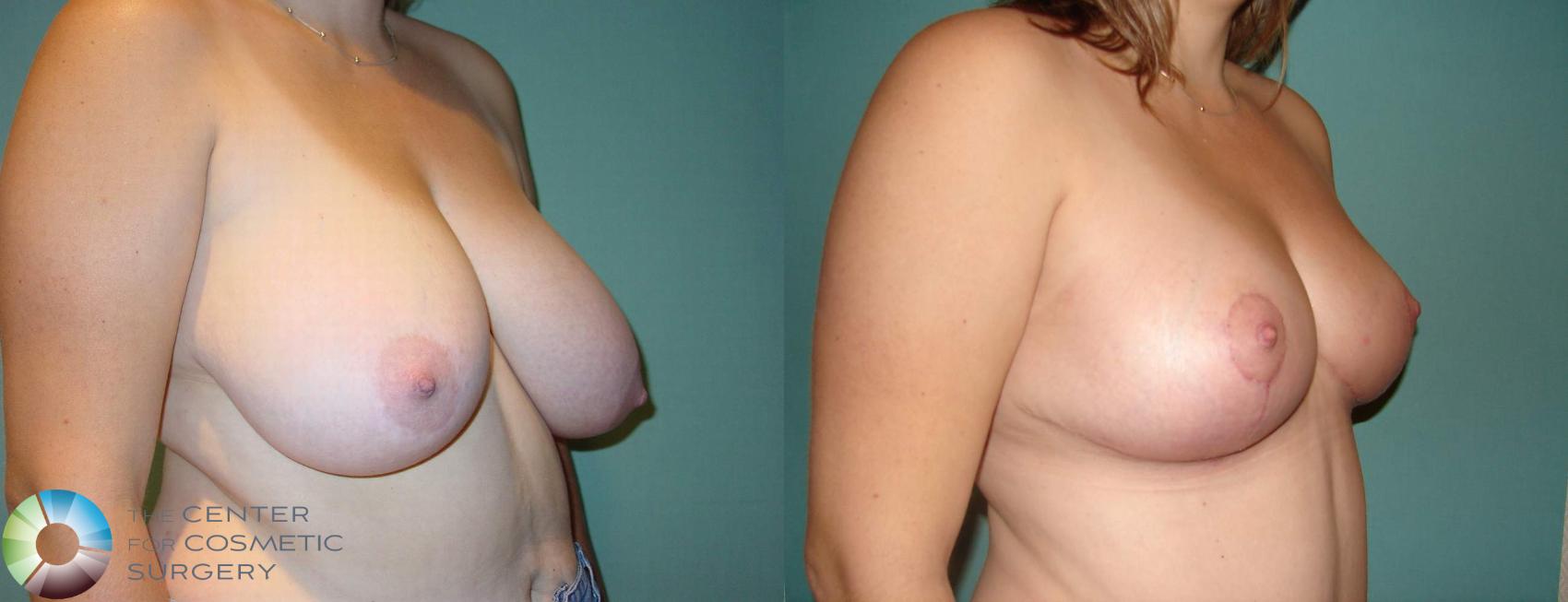 Before & After Breast Reduction Case 584 View #2 View in Golden, CO