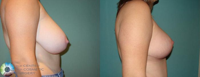 Before & After Breast Reduction Case 584 View #3 View in Golden, CO