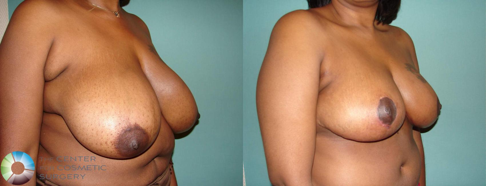 Before & After Breast Reduction Case 585 View #1 View in Golden, CO