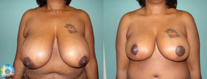 Before & After Breast Reduction Case 585 View #2 View in Golden, CO