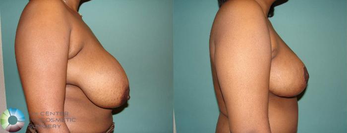 Before & After Breast Reduction Case 585 View #3 View in Golden, CO