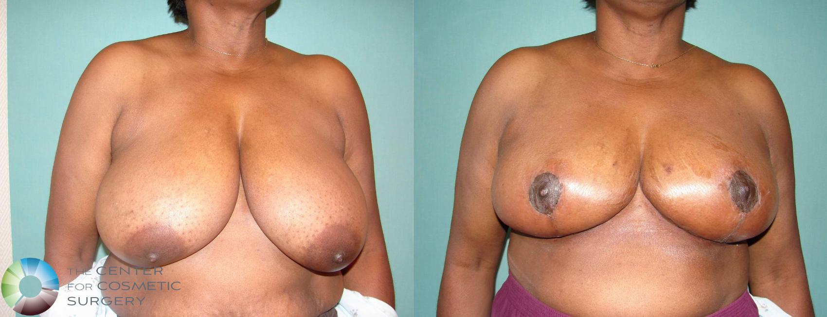 Before & After Breast Reduction Case 586 View #1 in Denver and Colorado Springs, CO