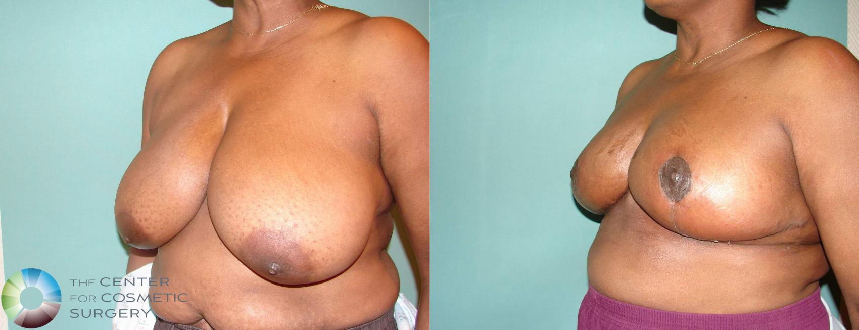 Before & After Breast Reduction Case 586 View #2 in Denver and Colorado Springs, CO