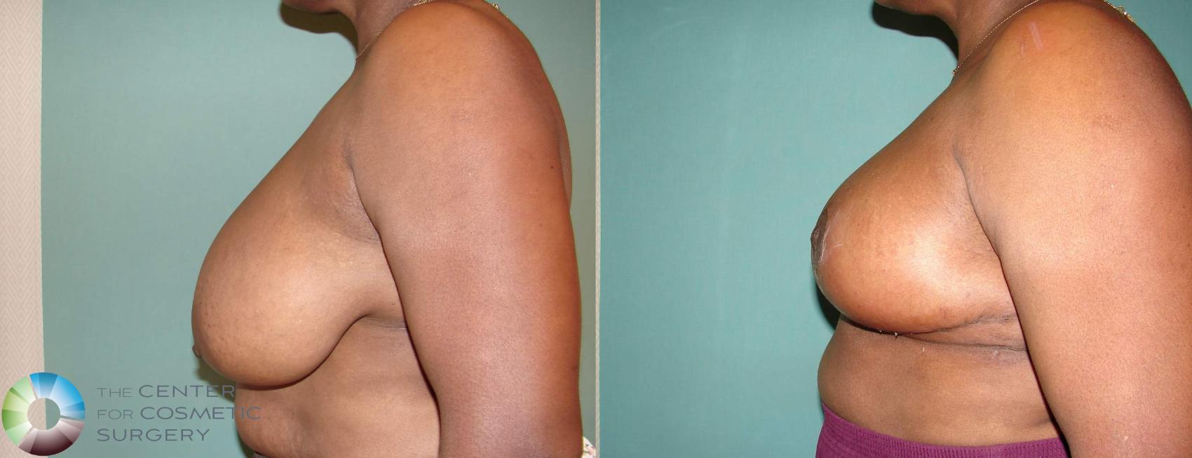 Before & After Breast Reduction Case 586 View #3 in Denver and Colorado Springs, CO