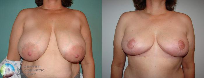 Before & After Breast Reduction Case 589 View #1 View in Golden, CO