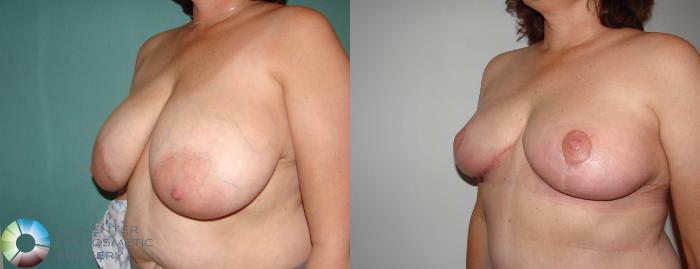 Before & After Breast Reduction Case 589 View #2 View in Golden, CO