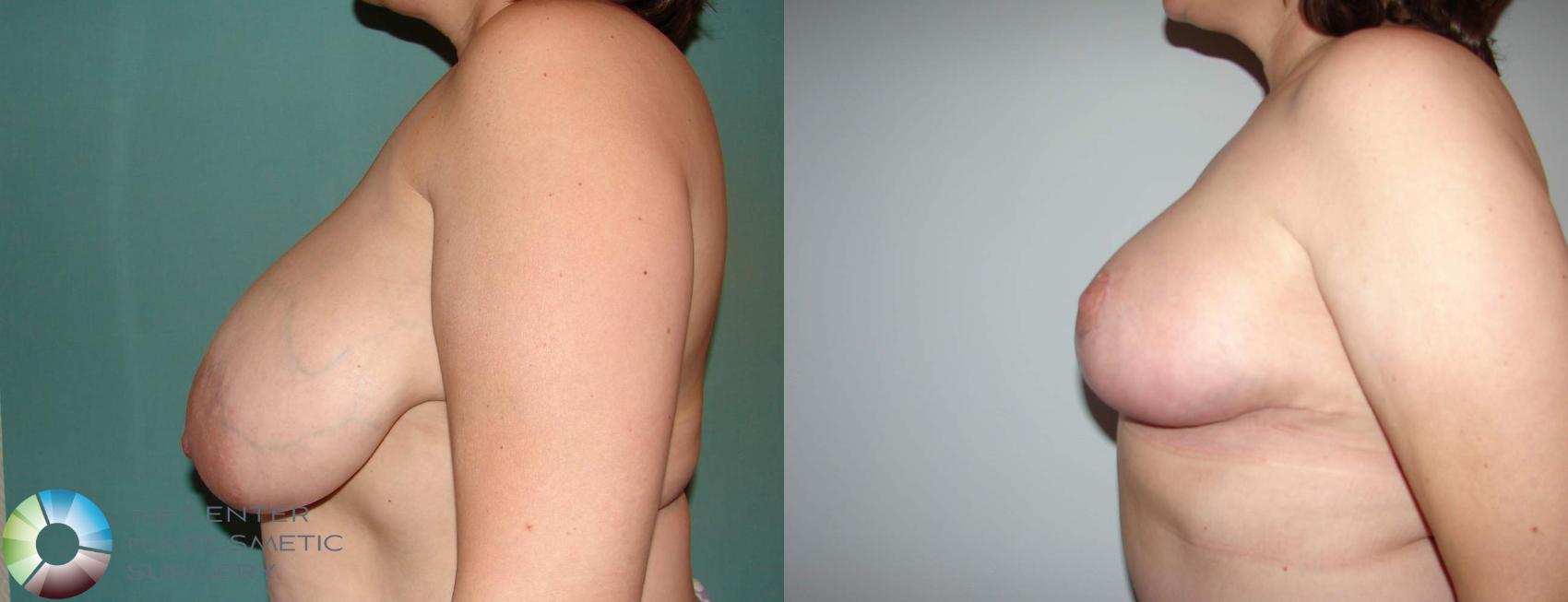 Before & After Breast Reduction Case 589 View #3 View in Golden, CO