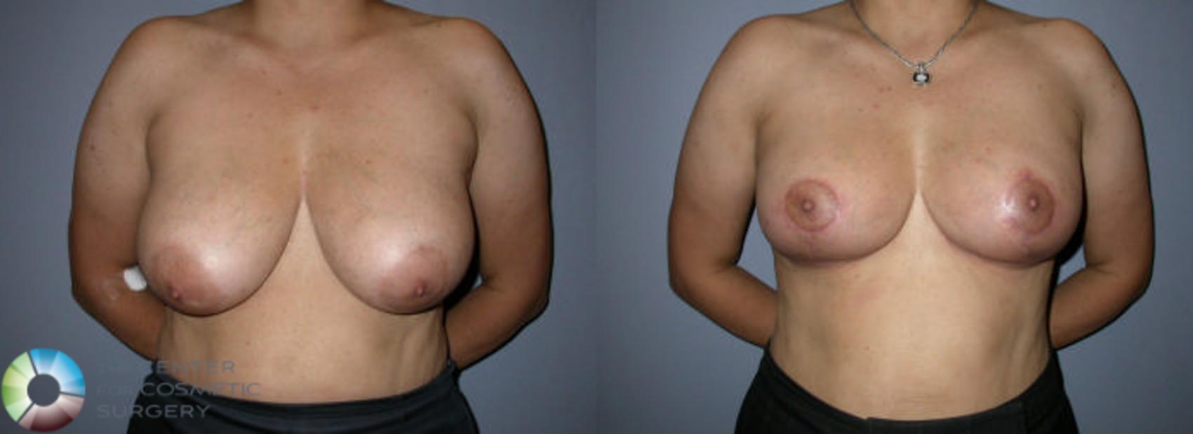 Breast Reduction Case 59 Before & After View #1 | Golden, CO | The Center for Cosmetic Surgery