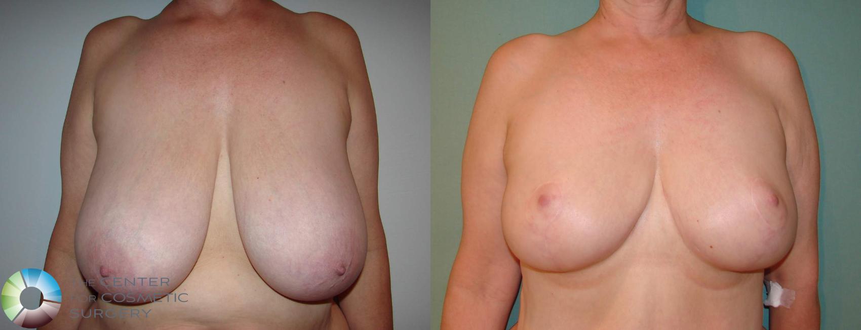 Before & After Breast Reduction Case 590 View #1 View in Denver & Golden, CO