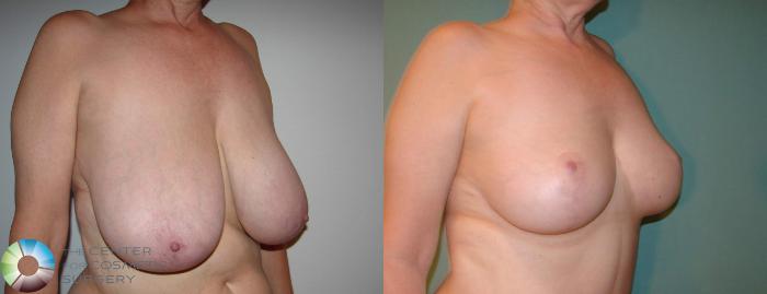 Before & After Breast Reduction Case 590 View #2 in Denver, CO