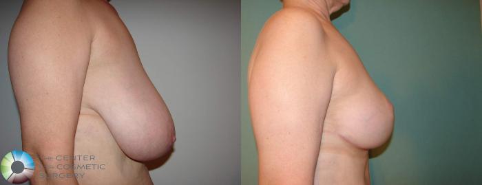 Before & After Breast Reduction Case 590 View #3 in Denver, CO