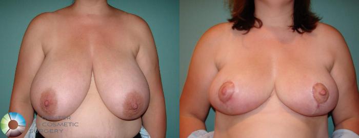 Before & After Breast Reduction Case 592 View #1 in Denver and Colorado Springs, CO