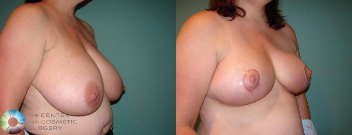Before & After Breast Reduction Case 592 View #2 in Denver and Colorado Springs, CO