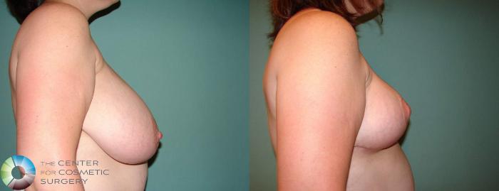 Before & After Breast Reduction Case 592 View #3 in Denver and Colorado Springs, CO