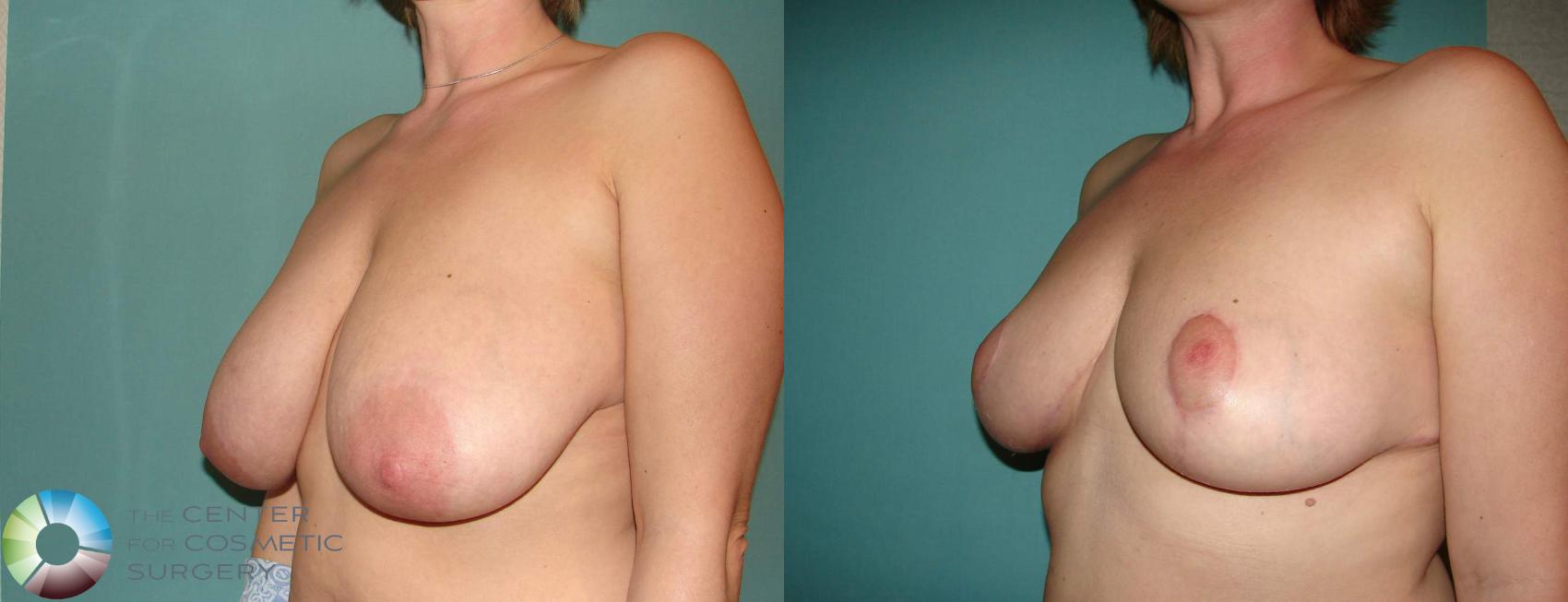 Before & After Breast Reduction Case 594 View #1 View in Denver & Golden, CO