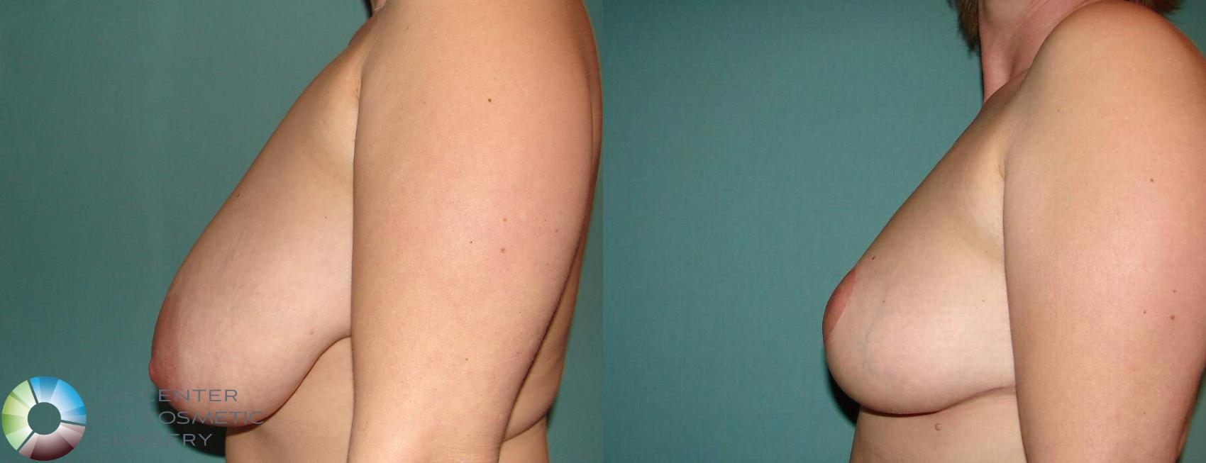 Before & After Breast Reduction Case 594 View #2 in Denver and Colorado Springs, CO