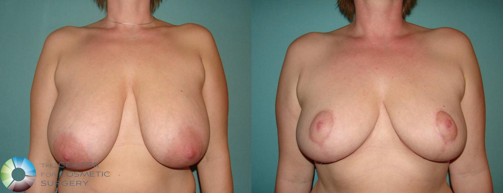 Before & After Breast Reduction Case 594 View #3 in Denver and Colorado Springs, CO