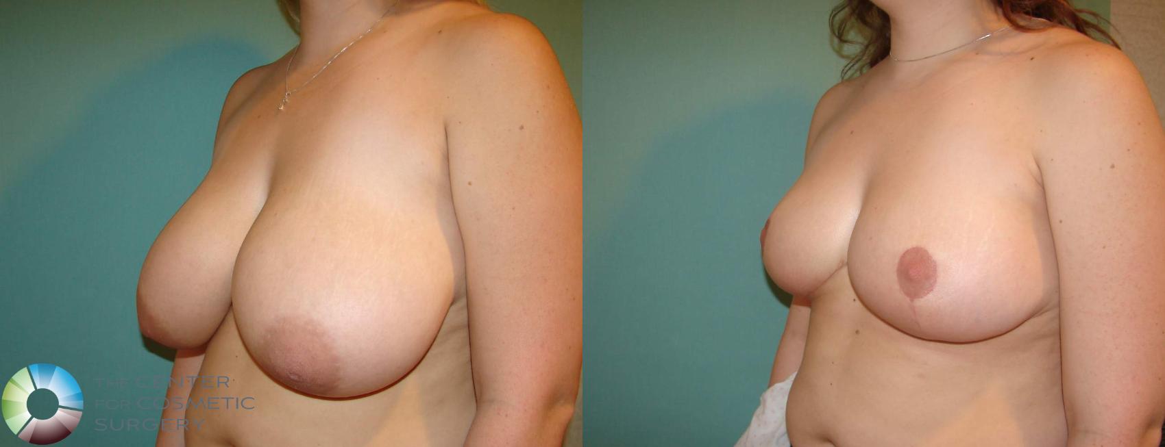 Before & After Breast Reduction Case 616 View #2 in Denver and Colorado Springs, CO