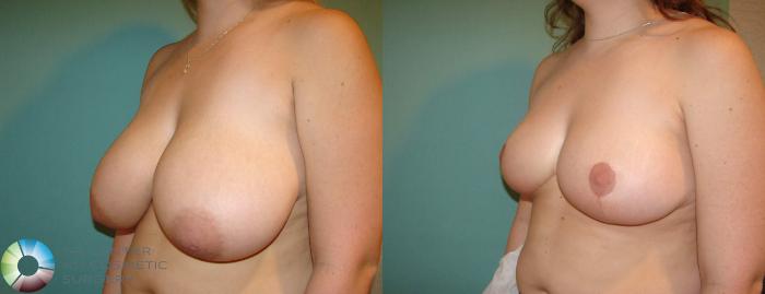 Before & After Breast Reduction Case 616 View #2 View in Golden, CO