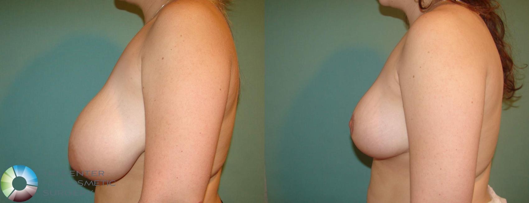 Before & After Breast Reduction Case 616 View #3 in Denver and Colorado Springs, CO