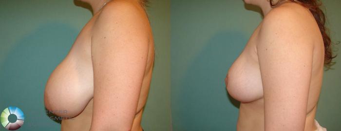 Before & After Breast Reduction Case 616 View #3 View in Golden, CO