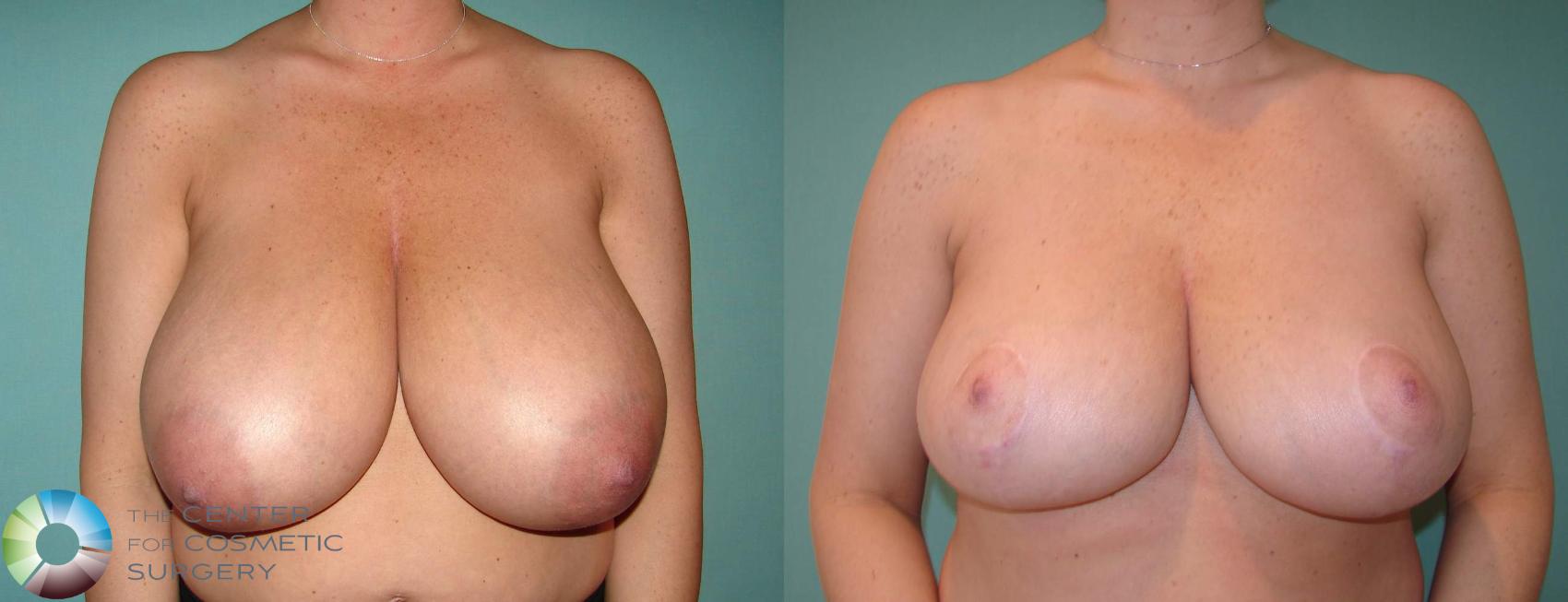 Before & After Breast Reduction Case 617 View #1 in Denver and Colorado Springs, CO