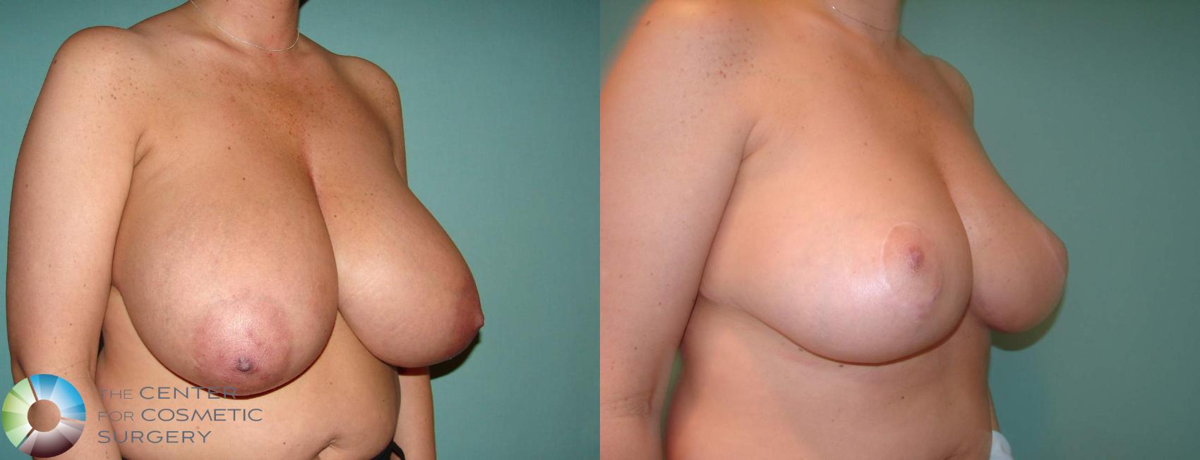 Before & After Breast Reduction Case 617 View #2 in Denver and Colorado Springs, CO
