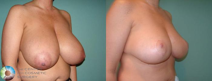 Before & After Breast Reduction Case 617 View #2 View in Golden, CO