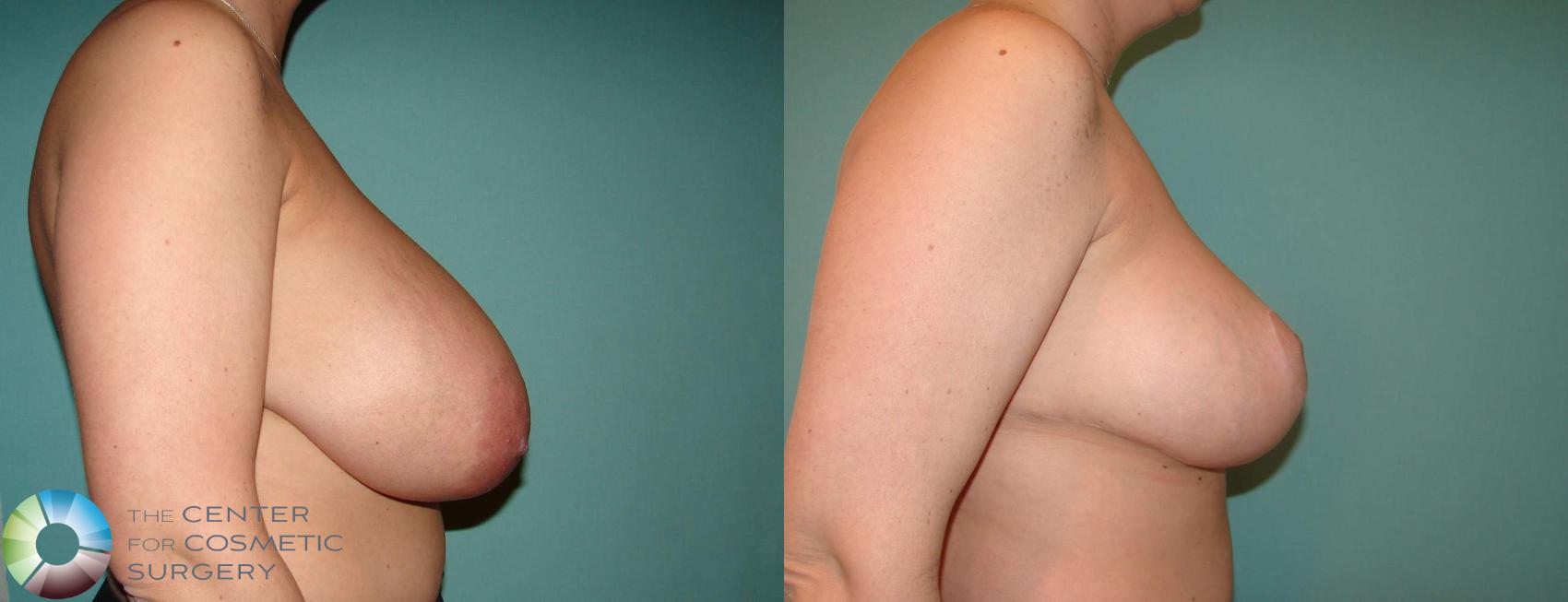 Before & After Breast Reduction Case 617 View #3 in Denver and Colorado Springs, CO