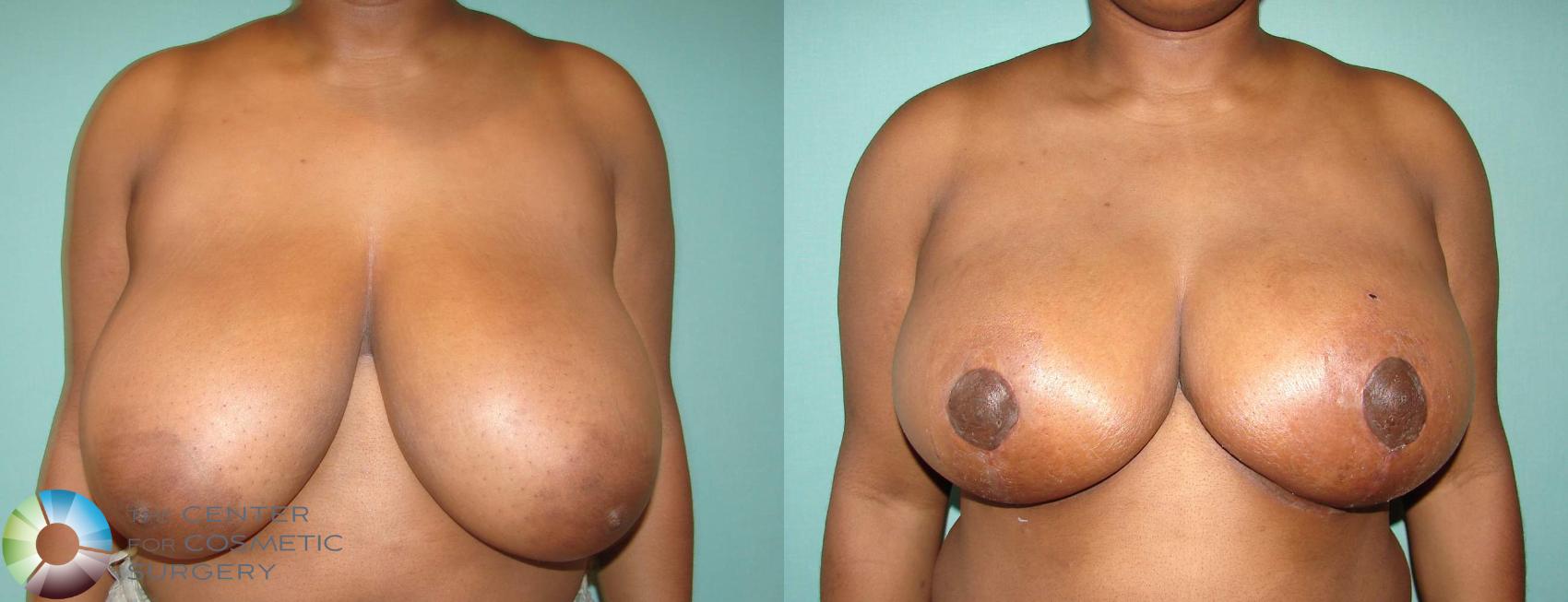 Before & After Breast Reduction Case 620 View #1 in Denver and Colorado Springs, CO