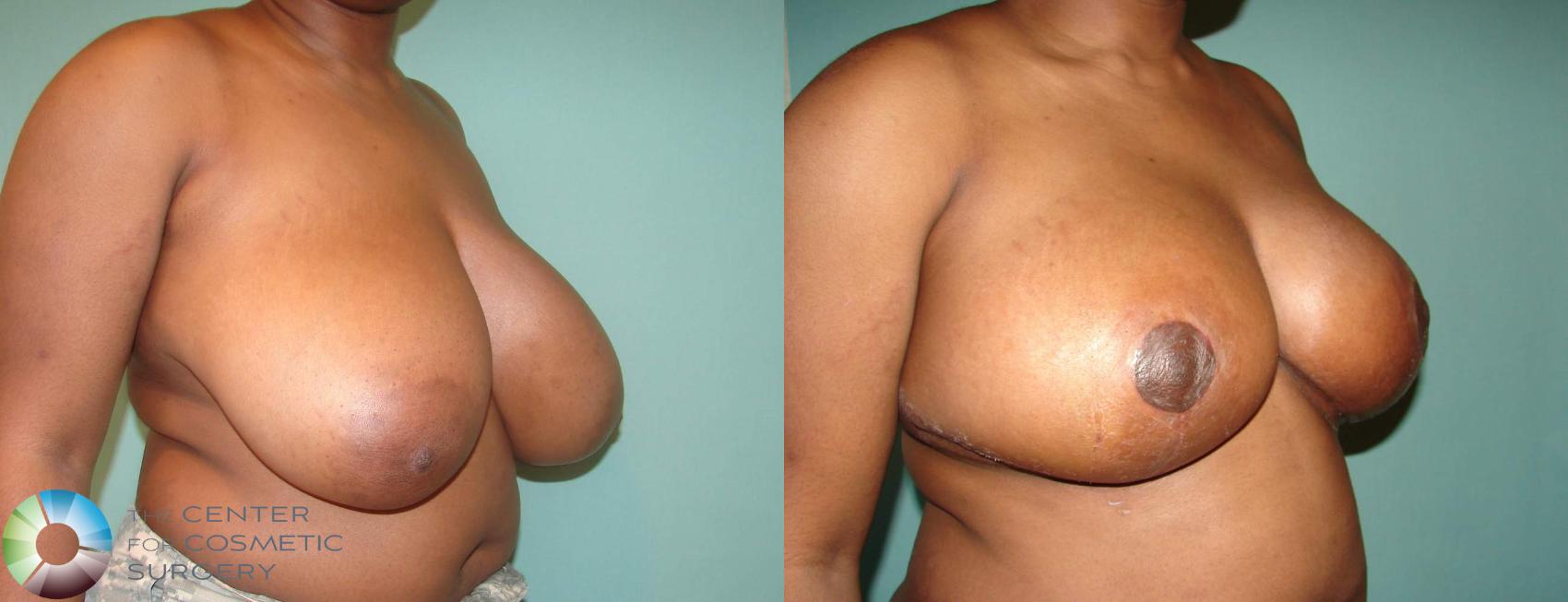 Before & After Breast Reduction Case 620 View #2 in Denver and Colorado Springs, CO