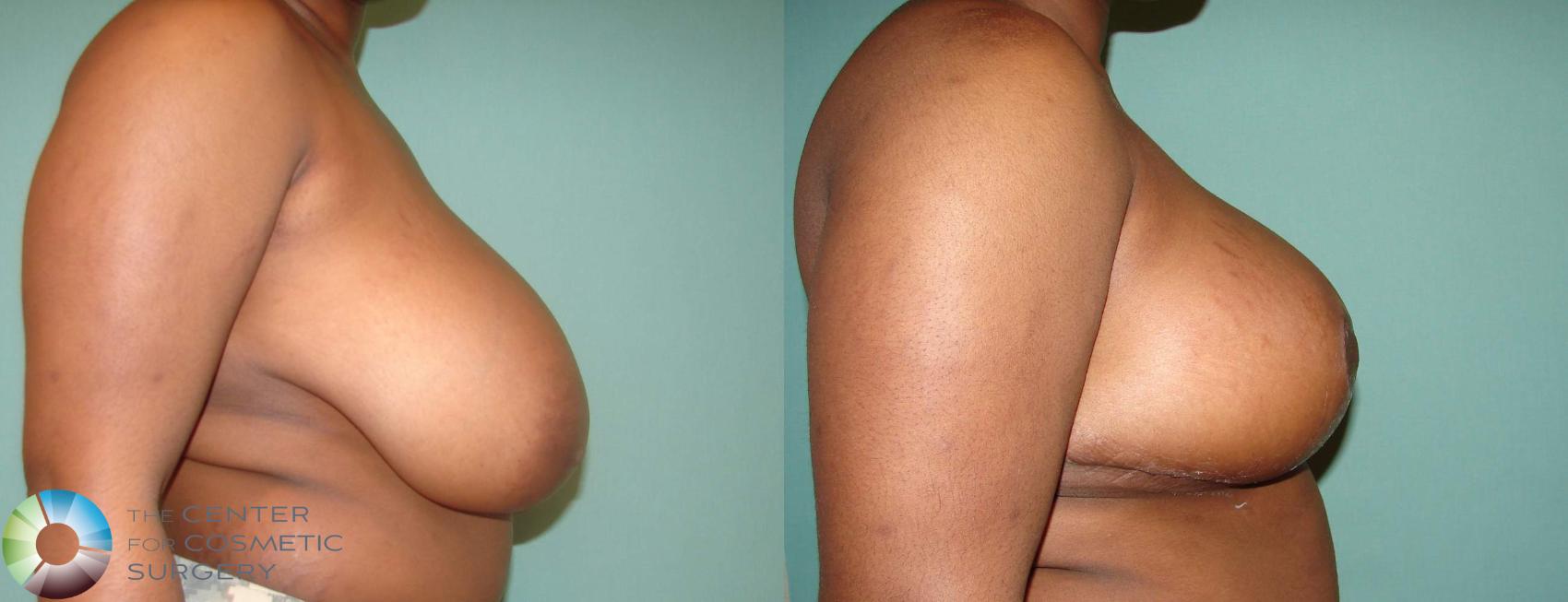 Before & After Breast Reduction Case 620 View #3 in Denver and Colorado Springs, CO