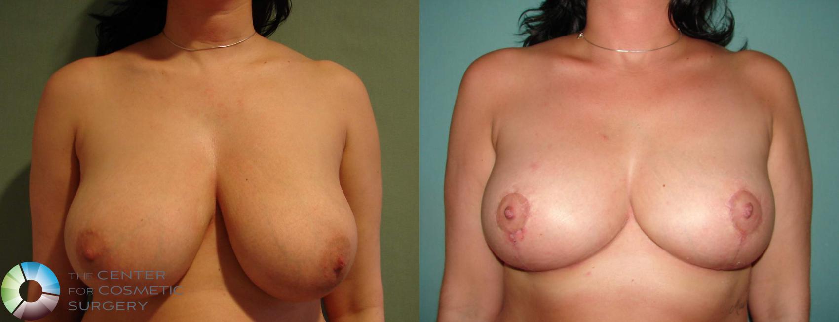 Before & After Breast Reduction Case 646 View #1 in Denver and Colorado Springs, CO