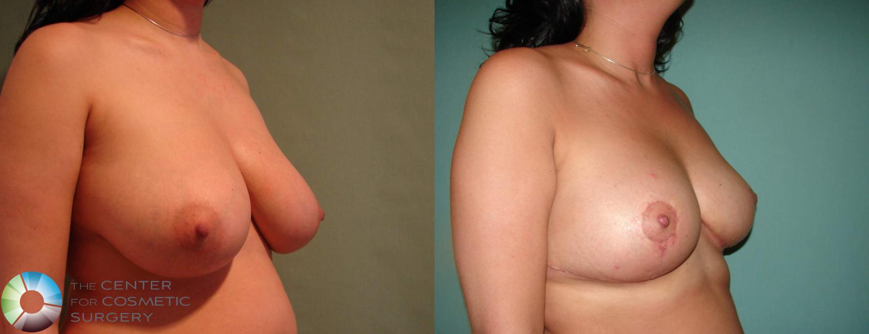 Before & After Breast Reduction Case 646 View #2 in Denver and Colorado Springs, CO