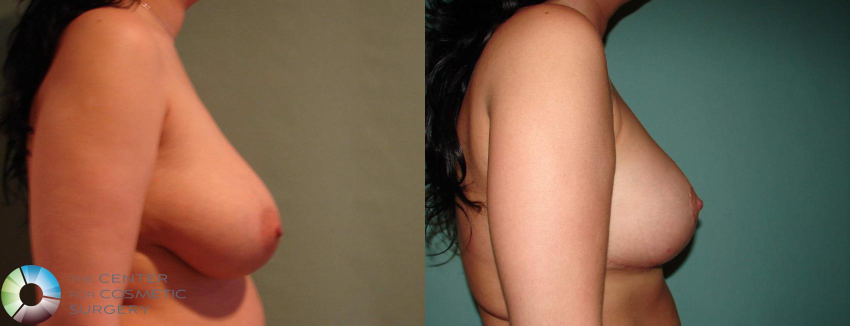 Before & After Breast Reduction Case 646 View #3 in Denver and Colorado Springs, CO