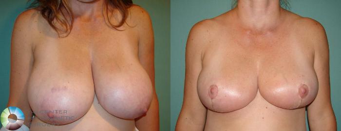Before & After Breast Reduction Case 647 View #1 View in Golden, CO