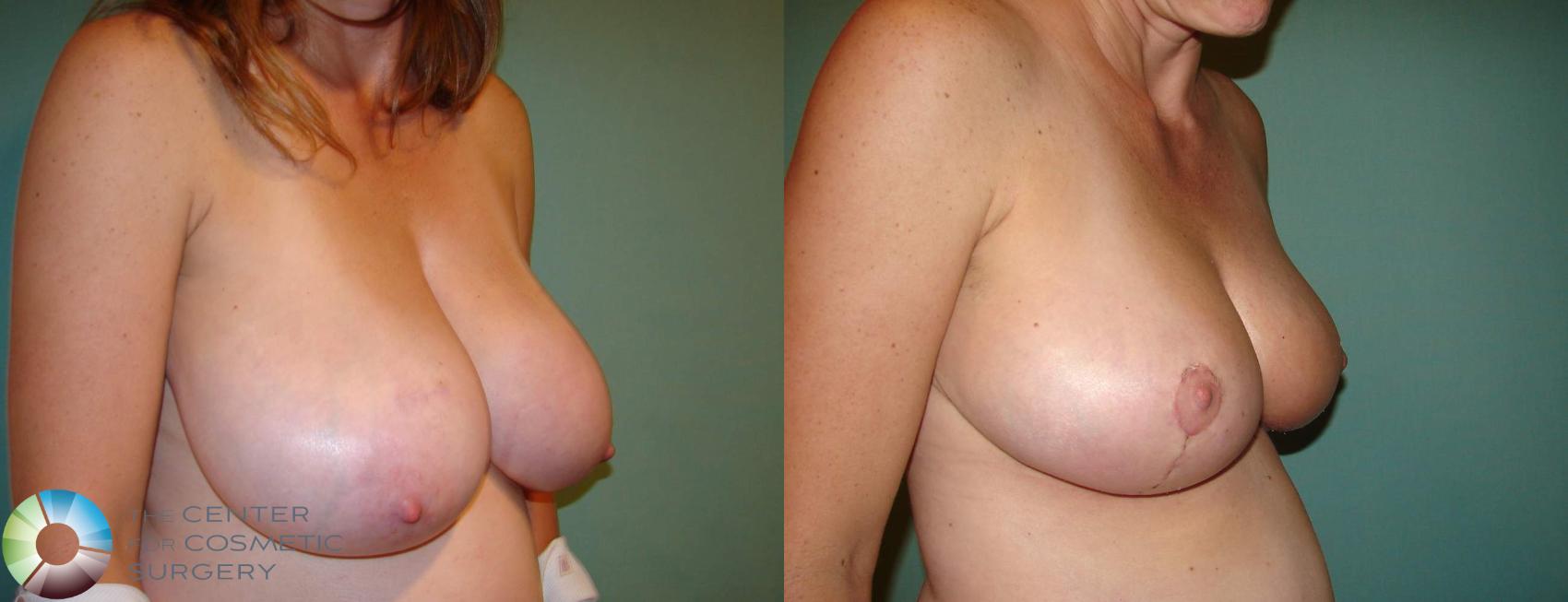 Before & After Breast Reduction Case 647 View #2 in Denver and Colorado Springs, CO