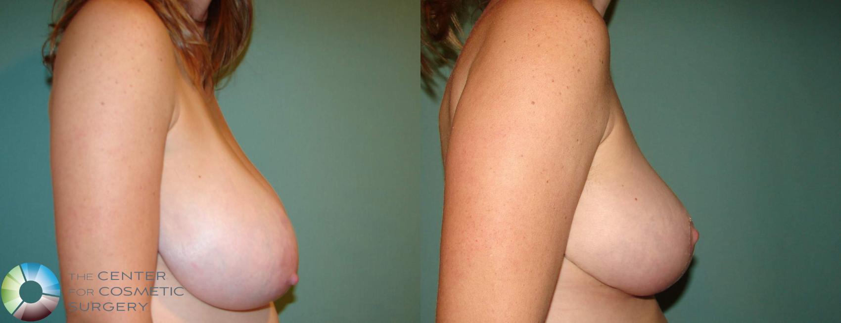 Before & After Breast Reduction Case 647 View #3 in Denver and Colorado Springs, CO
