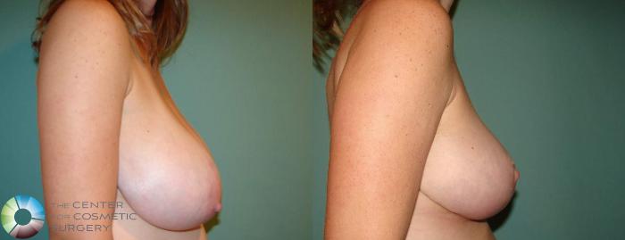 Before & After Breast Reduction Case 647 View #3 View in Golden, CO