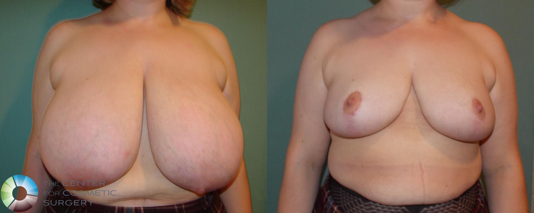 Before & After Breast Reduction Case 677 View #1 in Denver, CO