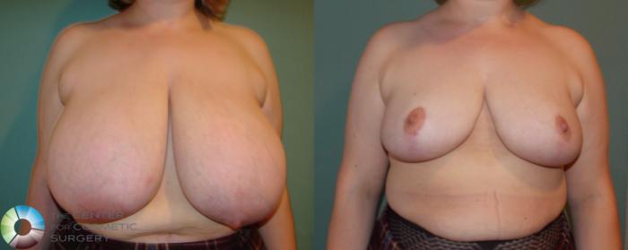 Before & After Breast Reduction Case 677 View #1 View in Golden, CO