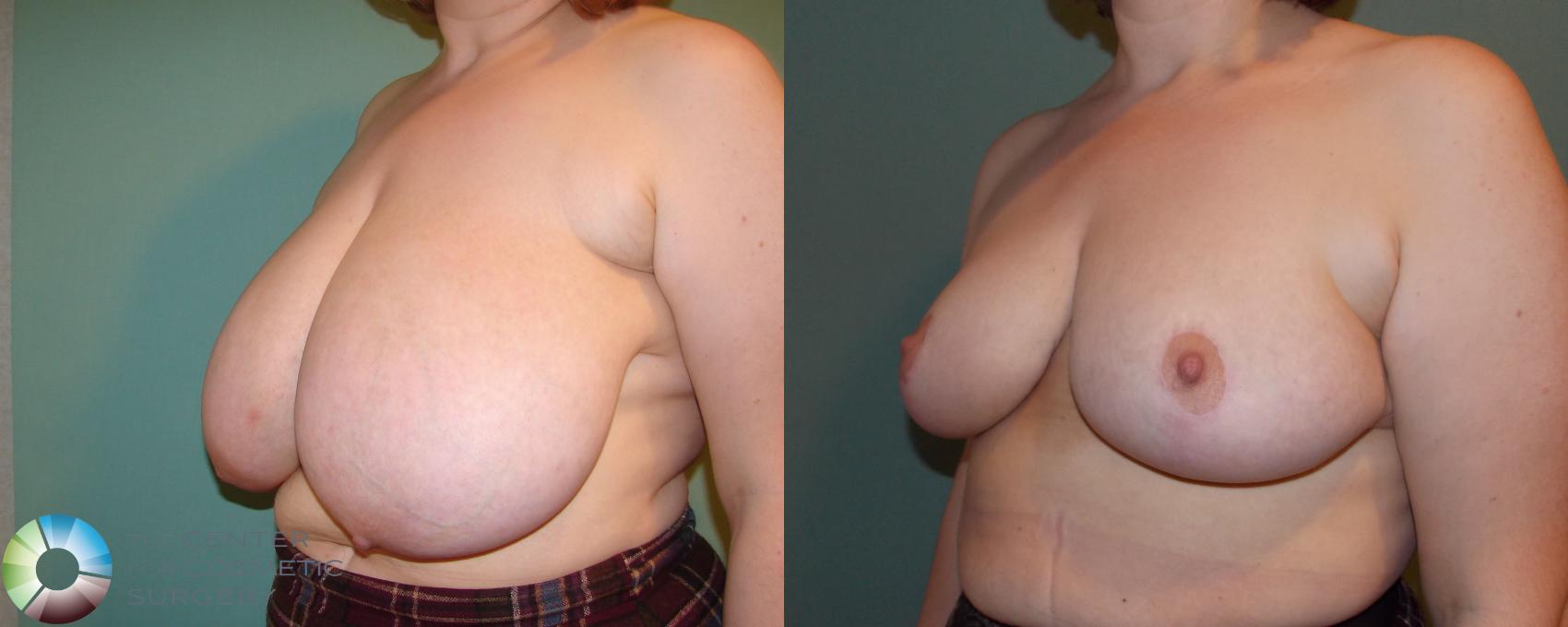 Before & After Breast Reduction Case 677 View #2 View in Denver & Golden, CO