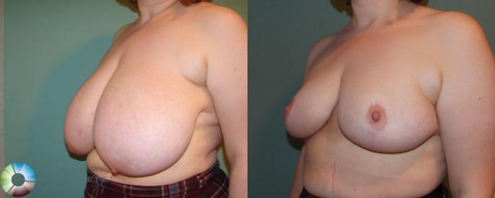 Before & After Breast Reduction Case 677 View #2 View in Golden, CO