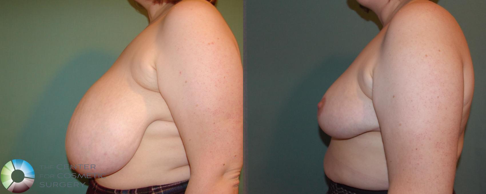 Before & After Breast Reduction Case 677 View #3 View in Golden, CO